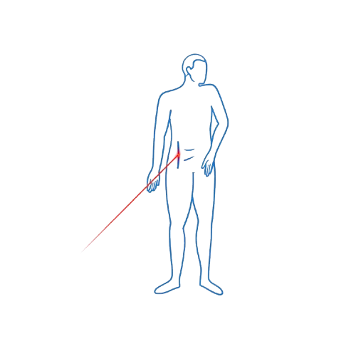 Laser Therapy